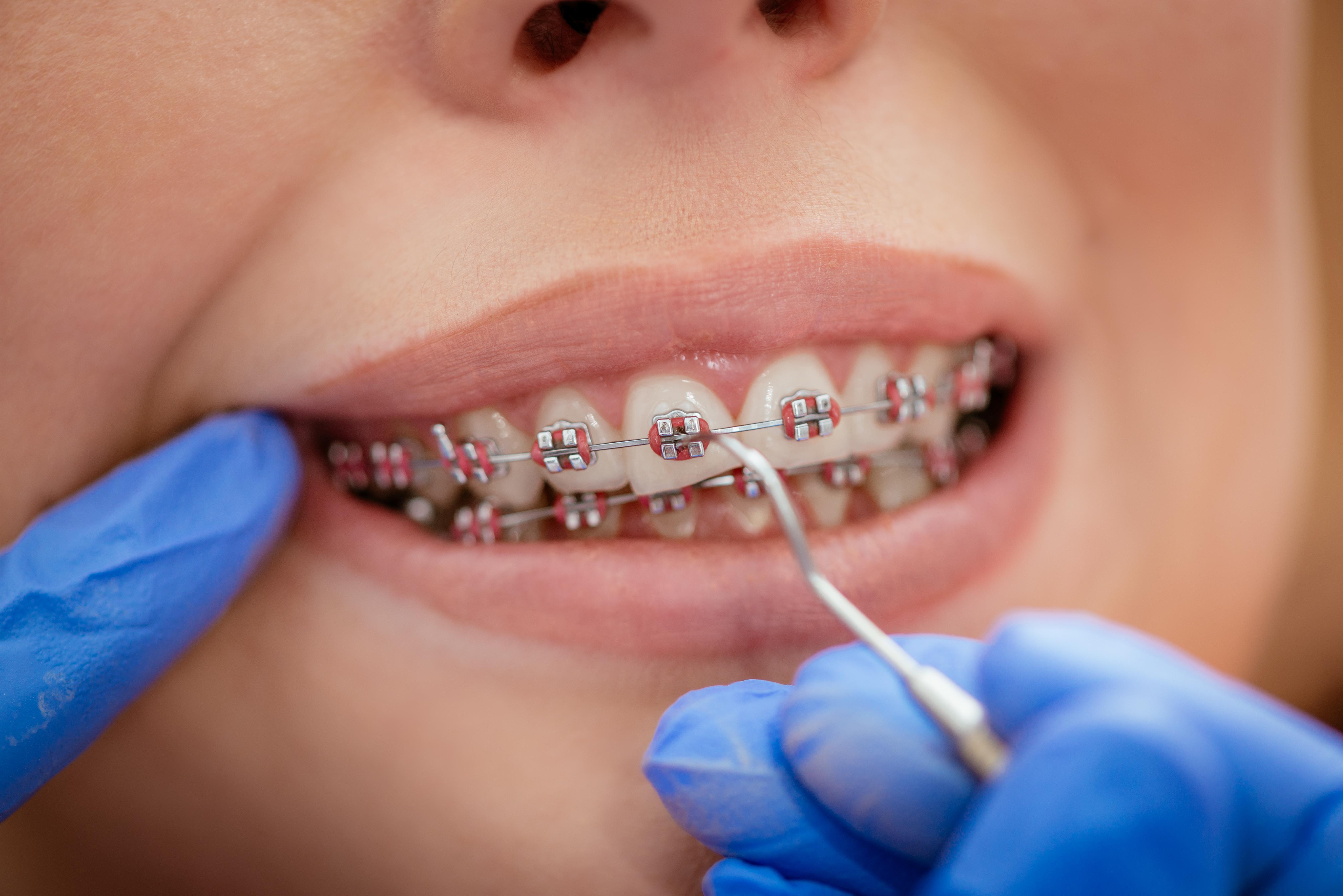 Ortodontik Bozuklukların Nedenleri || Konya Diş Hekimi | Üsame GÜNDÜZ 