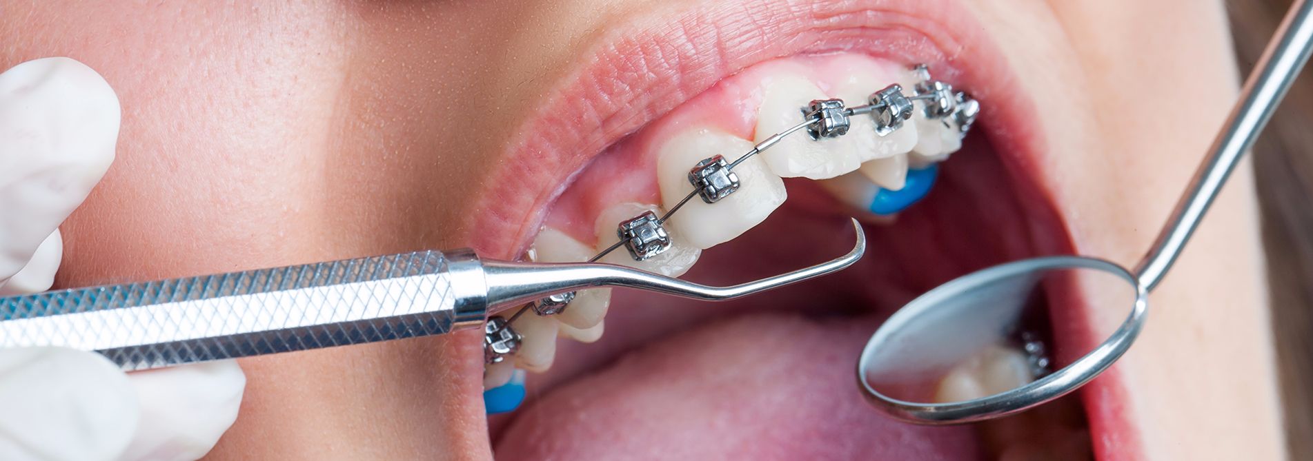 Ortodontist (Tel Tedavisi) || Konya Diş Hekimi | Üsame GÜNDÜZ 