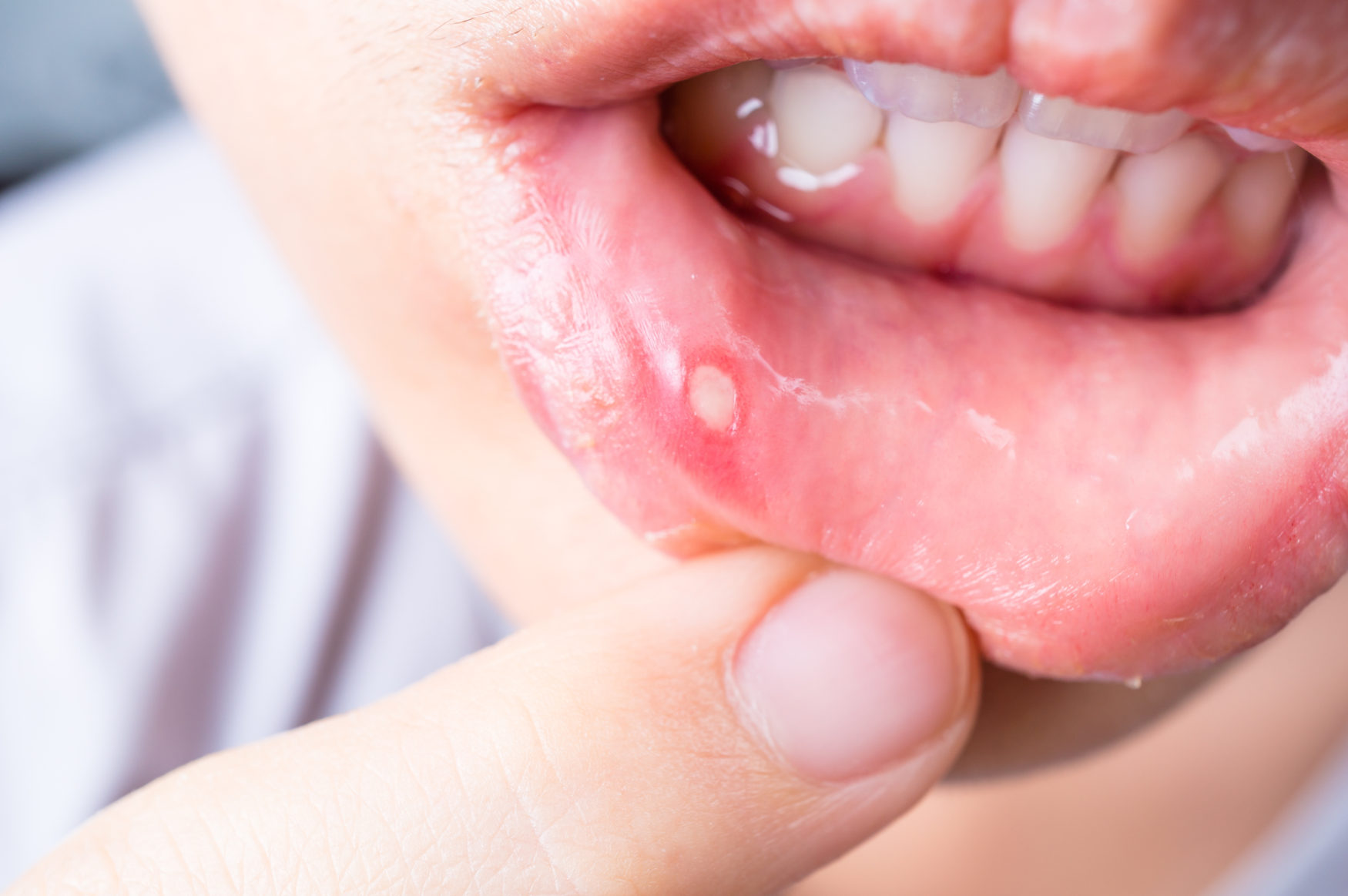 Aft Nedir? Aft Tedavisi Nasıl Yapılır? Diş Hekimi | Üsame GÜNDÜZ