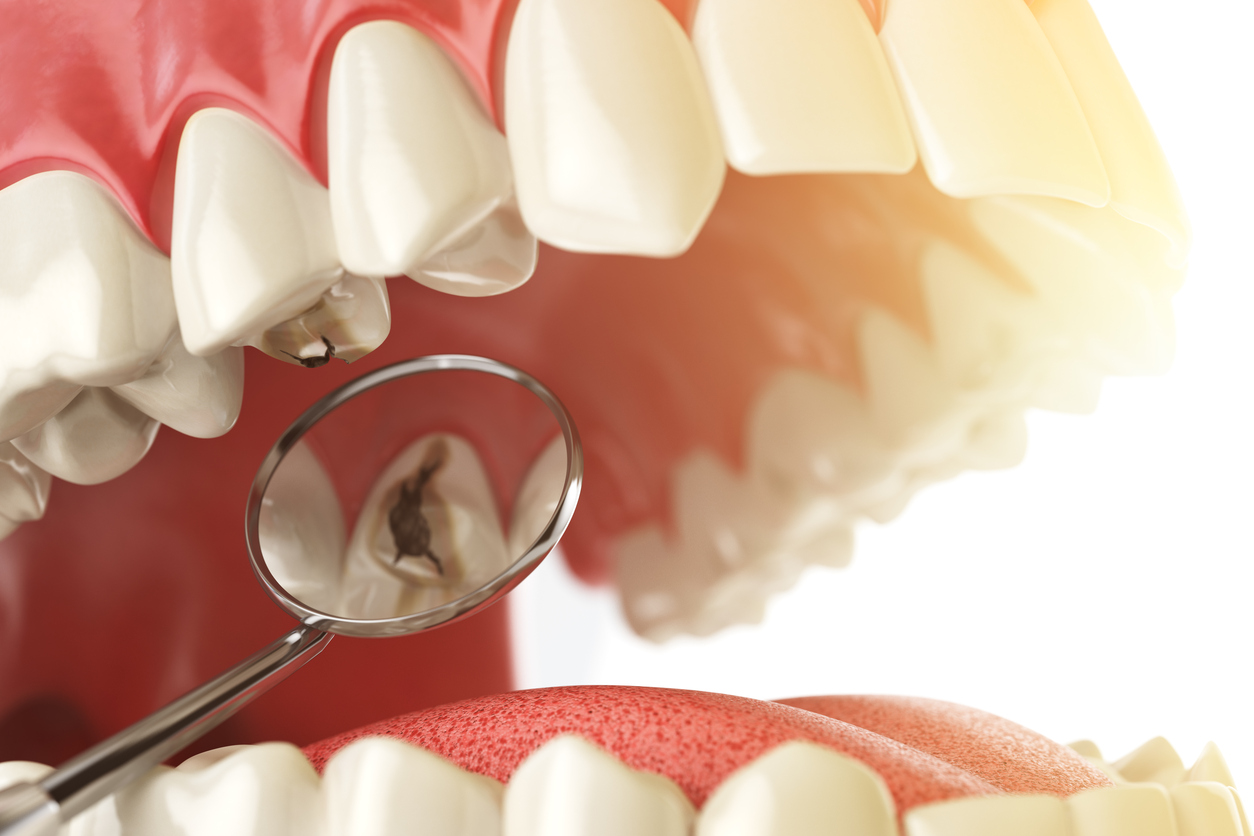 Diş Çürüğü Nasıl Engellenebilir? || Konya Diş Hekimi | Üsame GÜNDÜZ 