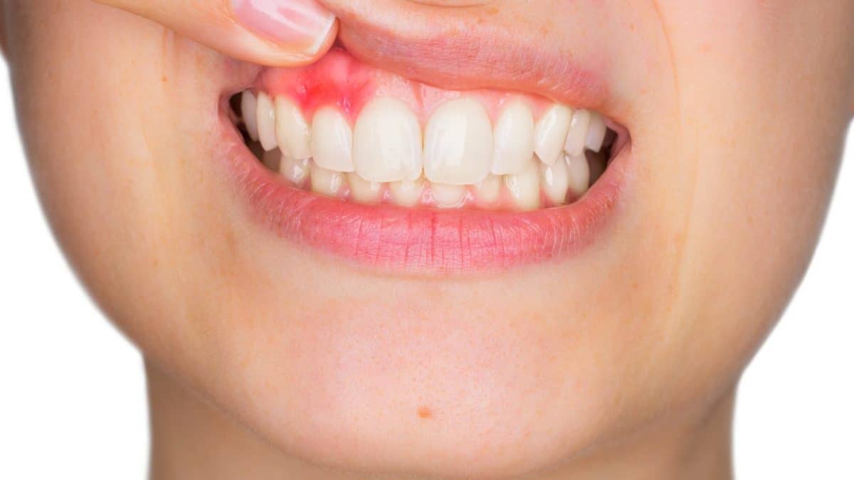 Diş Apsesi ve Tedavisi || Konya Diş Hekimi | Üsame GÜNDÜZ 