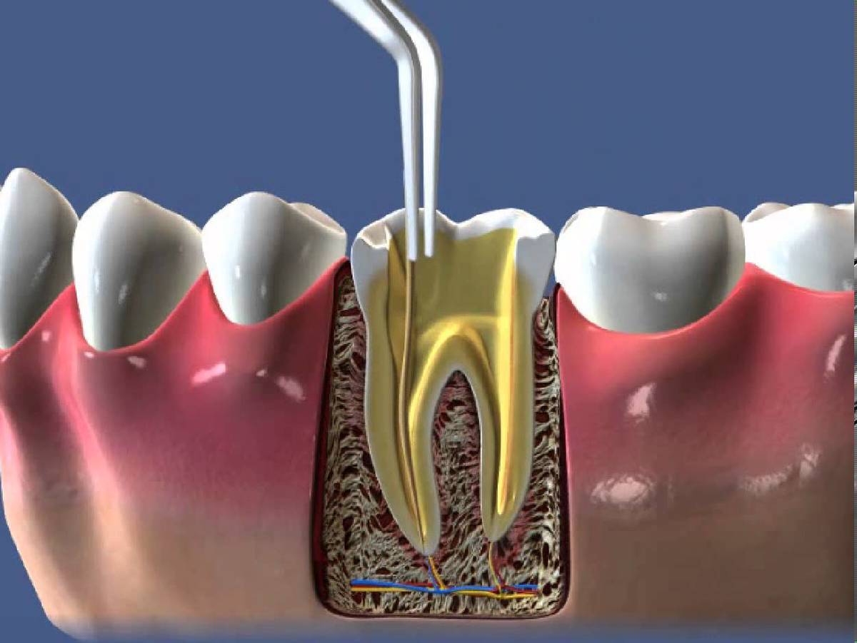 Kanal Tedavisi Nedir? || Konya Diş Hekimi | Üsame GÜNDÜZ 