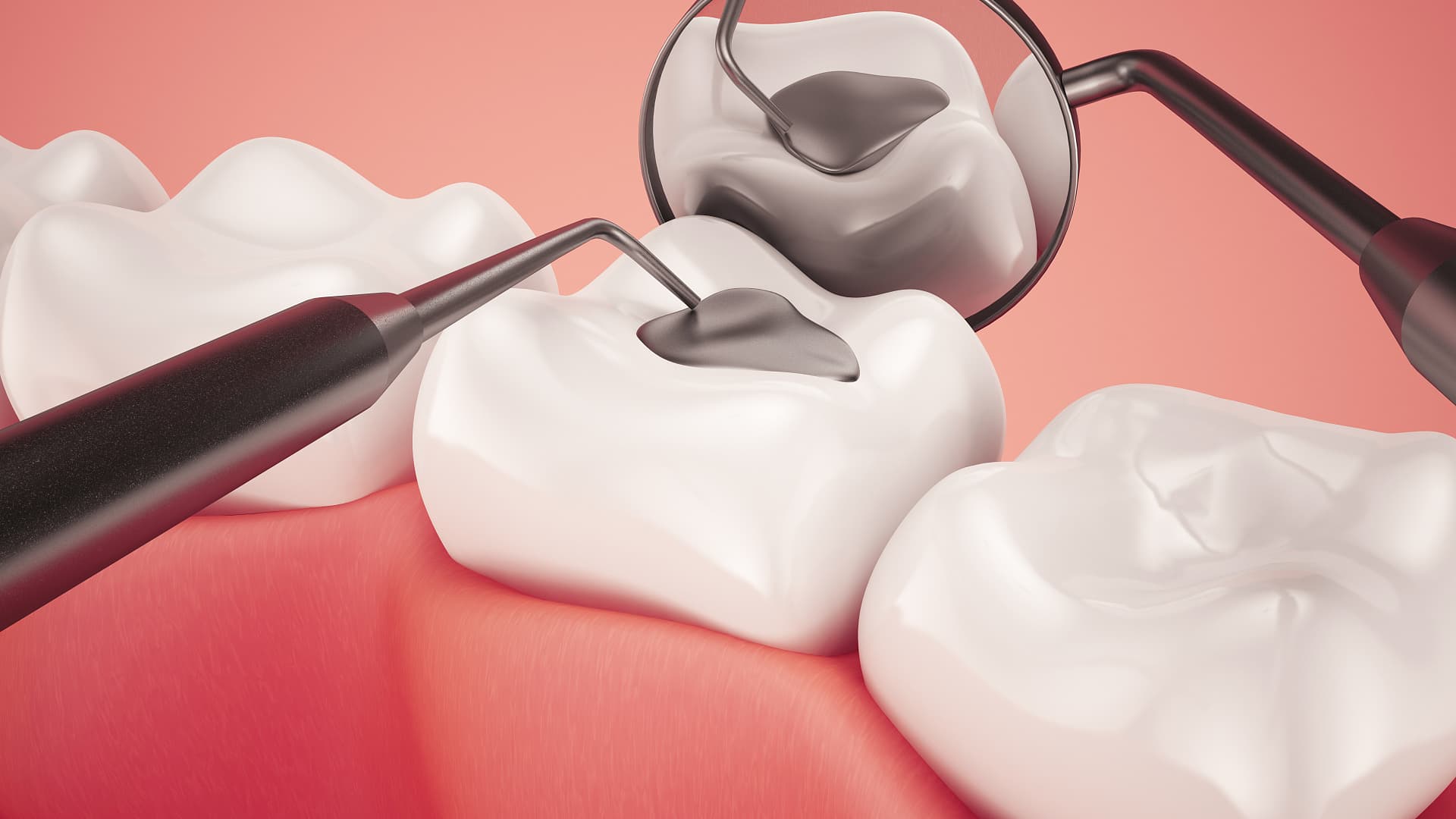 Amalgamı Niçin Tercih Ediyoruz? || Konya Diş Hekimi | Üsame GÜNDÜZ 