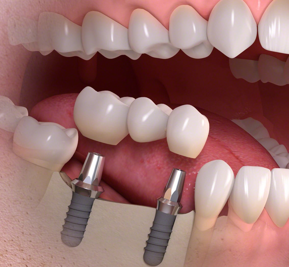 Protezlerde İmplant Desteği || Konya Diş Hekimi | Üsame GÜNDÜZ 