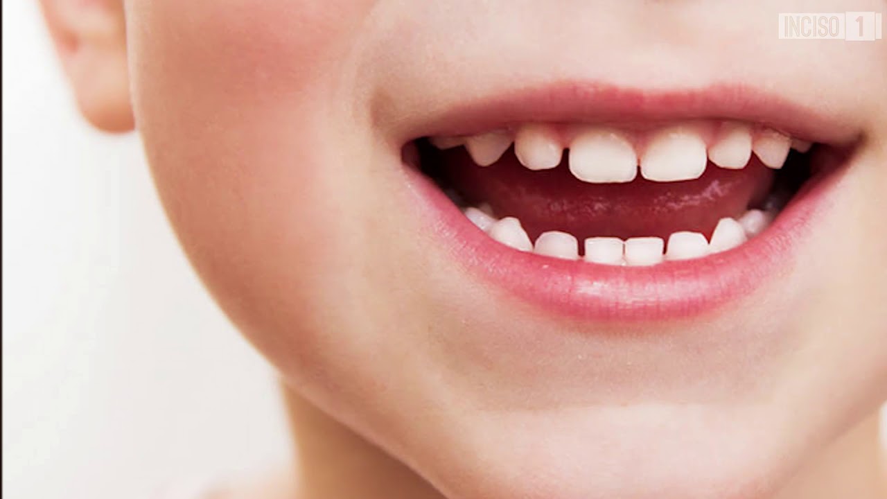 Süt Dişlerinde Dolgu Tedavisi - Süt Dişi Dolgusu Diş Hekimi | Üsame GÜNDÜZ