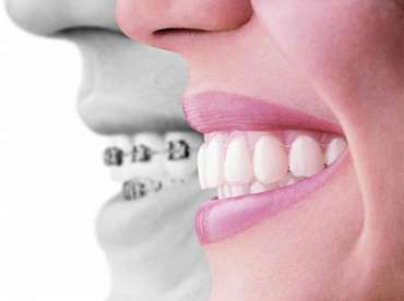 Ortodontik Tedavi Süresinde Kontroller  || Konya Diş Hekimi | Üsame GÜNDÜZ 