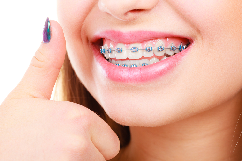 Ortodontik Tedavilerin Süresi || Konya Diş Hekimi | Üsame GÜNDÜZ 