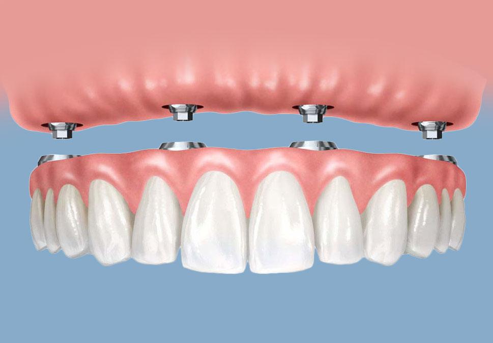 Protez Çeşitleri || Konya Diş Hekimi | Üsame GÜNDÜZ 