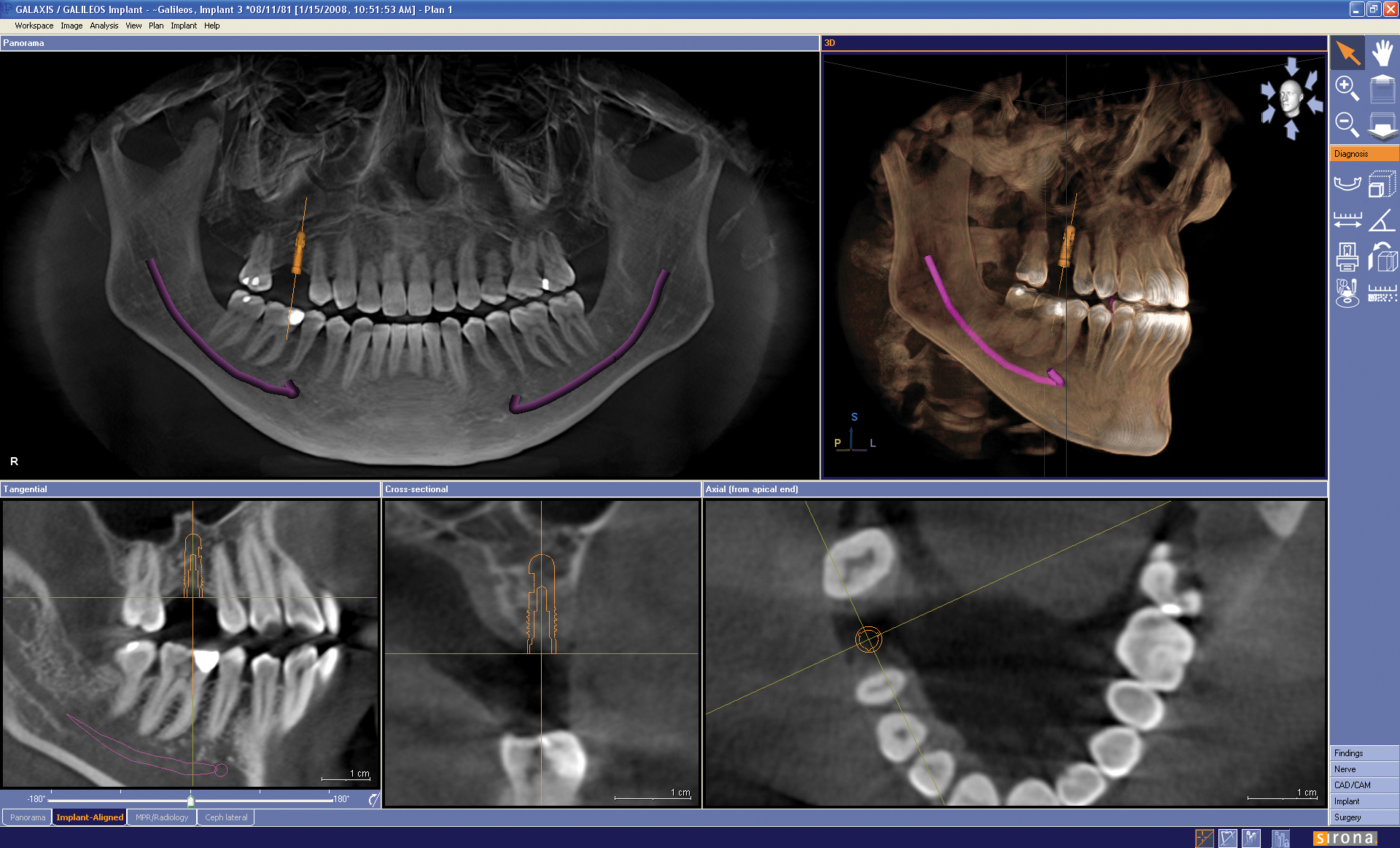  3D ile Implant || Konya Diş Hekimi | Üsame GÜNDÜZ