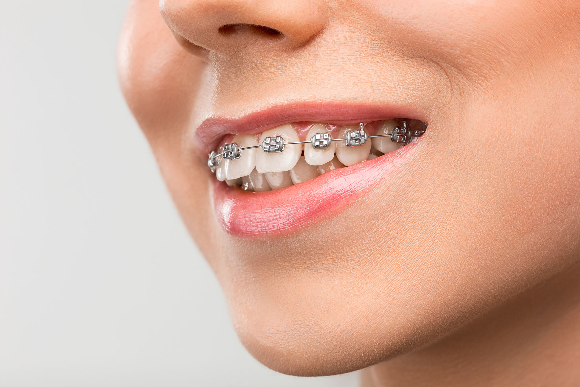 Ortodonti || Konya Diş Hekimi | Üsame GÜNDÜZ