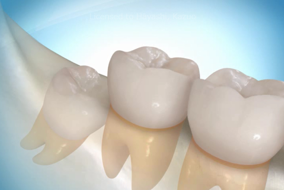 Gömülü Diş Çekimi || Konya Diş Hekimi | Üsame GÜNDÜZ